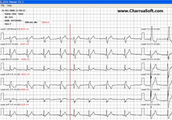 ECG Viewer screenshot 4