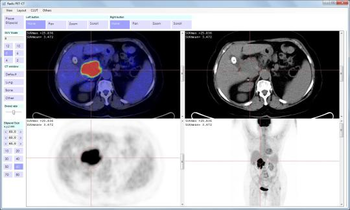 Radis PET-CT screenshot 2